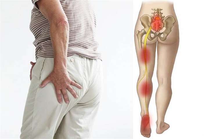 ما هو عرق النسا؟